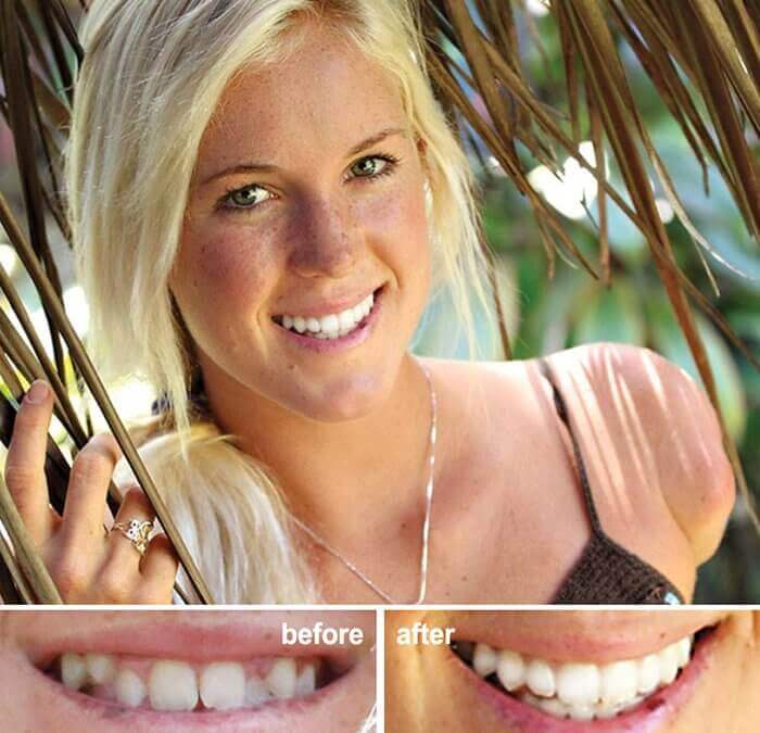 brackets damon