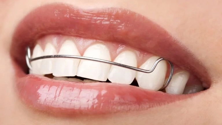 La importancia de la retención después del tratamiento de ortodoncia en acapulco